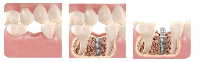 IMPLANTE DENTÁRIO