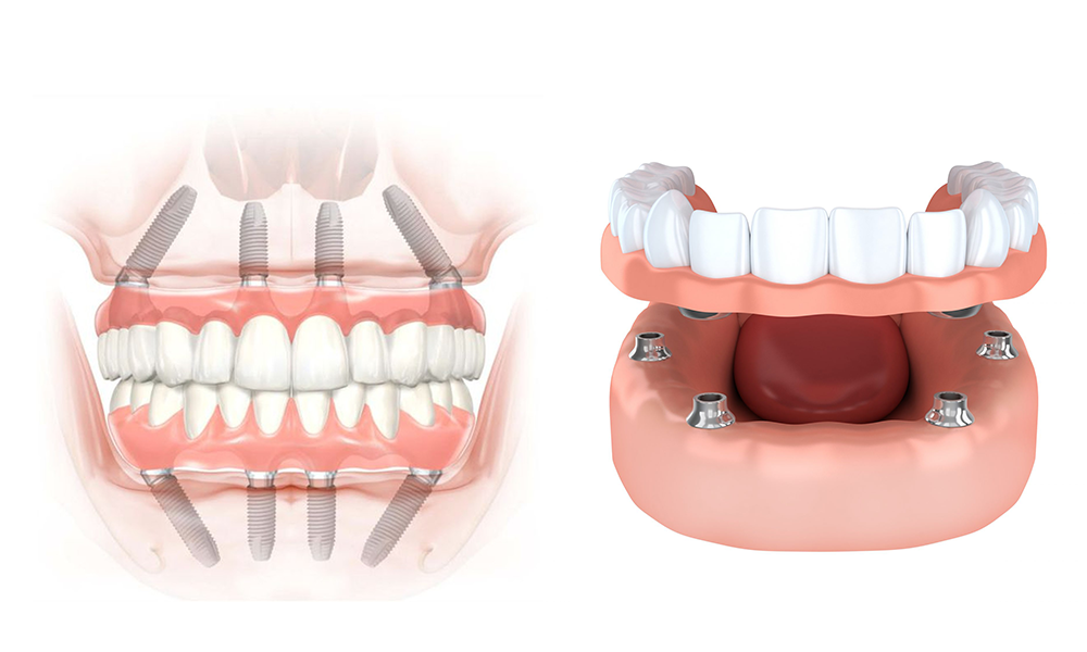 SOLUÇÃO ALL-ON-4 : IMPLANTES + PROTESES